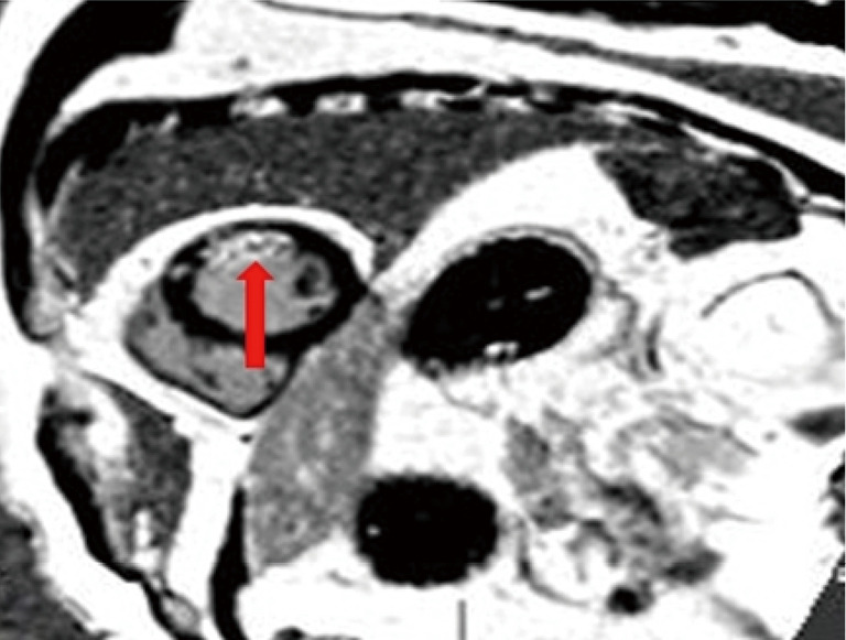 Epicardial fat volume assessment and strain analysis by cardiac magnetic resonance: a novel method for evaluating microcirculation dysfunction after myocardial infarction.