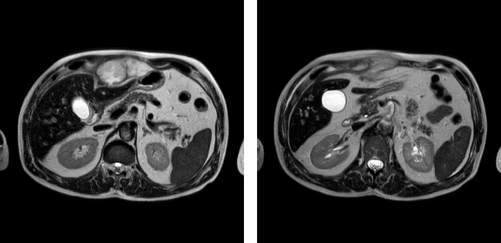 A Case of <i>Nocardia kroppenstedtii</i> Infection Successfully Treated With a Multidisciplinary Approach.