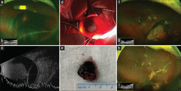 Surgical treatment of uveal melanoma: Exoresection versus endoresection.