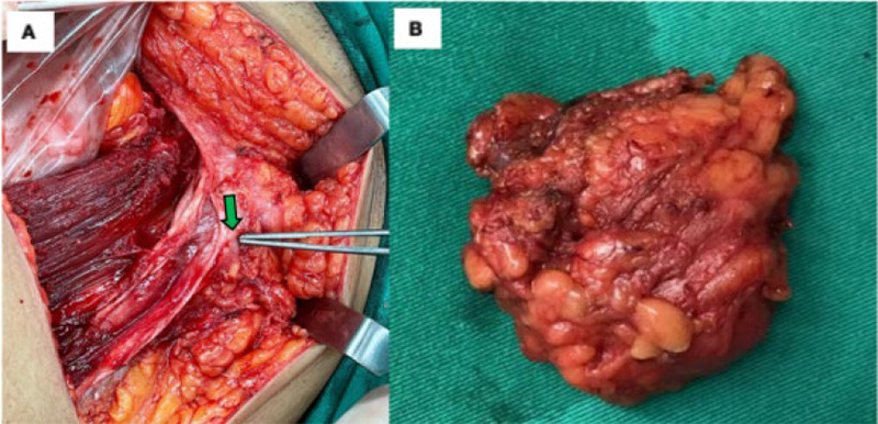 Spontaneous abdominal wall endometriosis: A case report.