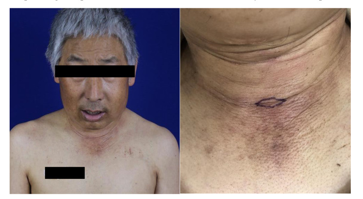 Clinicopathological diagnosis of morphea-like carcinoma en cuirasse in the neck: a rare presentation of lung cancer.