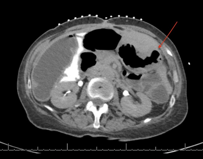 Hybrid Endoscopic/Fluoroscopic Gastrostomy Tube Placement: Case Report of a Novel Technique.