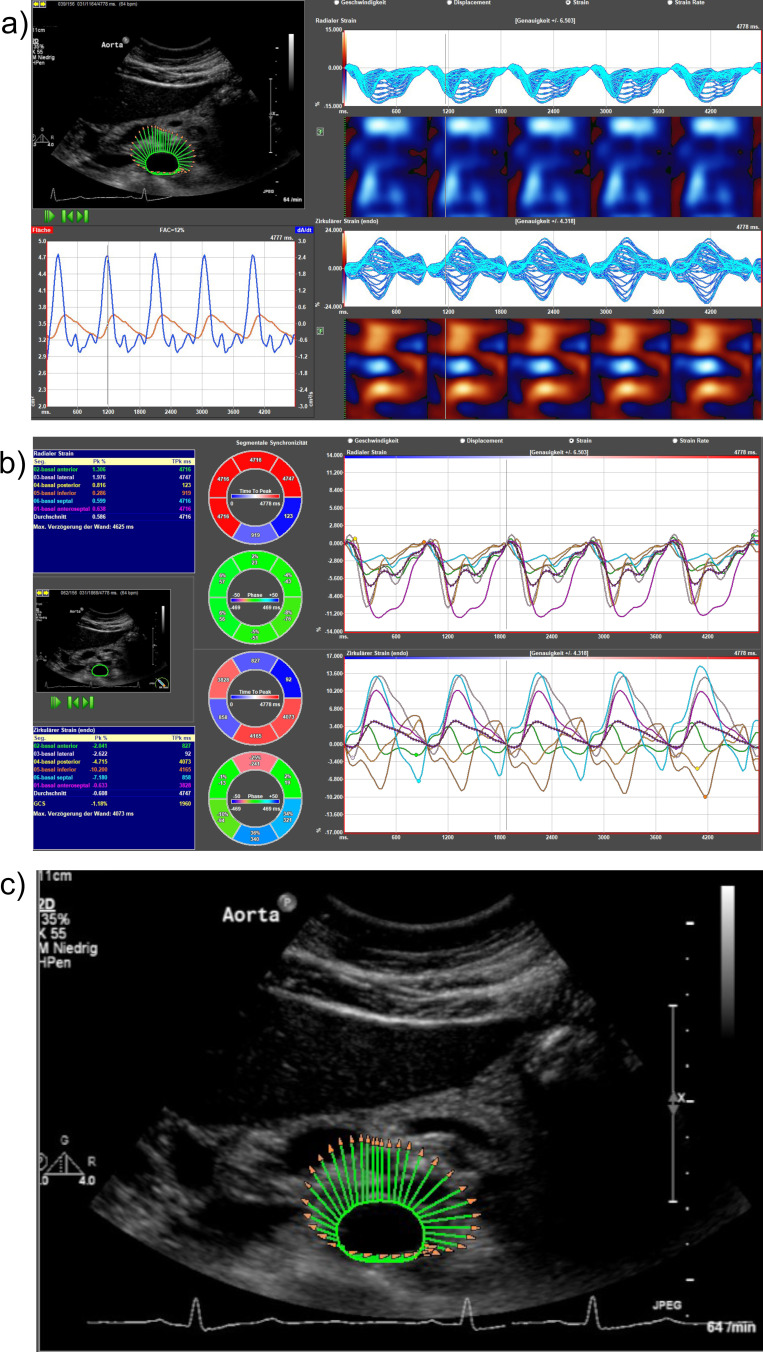 Blood Eosinophil Count in Asthma Is Associated With Increased Abdominal Aortic Diameter and Increased Vascular Stiffness.