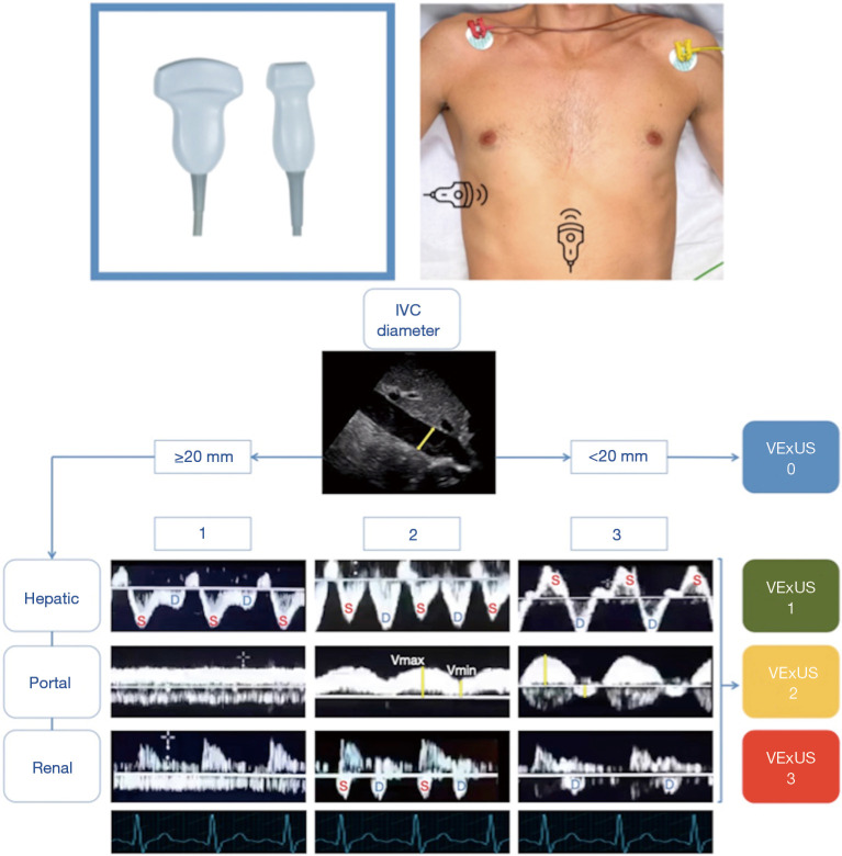 Ultrasound imaging of congestion in heart failure: a narrative review.