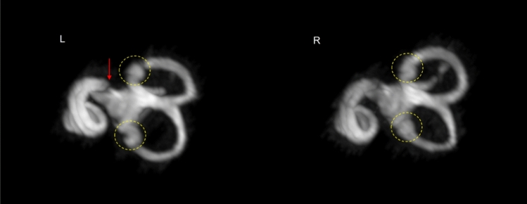 Morphology of the human inner ear and vestibulocochlear nerve assessed using 7 T MRI.