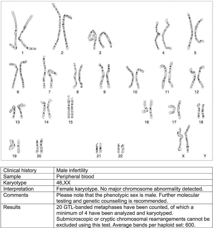 46,XX Testicular Disorder of Sex Development (DSD) Presenting With Male Hypogonadism.