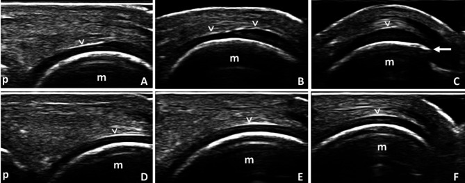 Is thickened hyaline cartilage on ultrasound a sign of osteoarthritis? A within-person, between-joint pilot study.