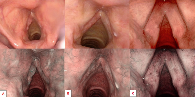 Complete response of laryngeal papillomatosis after HPV vaccination.