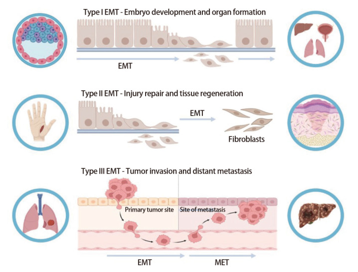 [Epithelial-mesenchymal Transition: Biological Basis and Clinical Prospects  of Lung Cancer Invasion, Metastasis, and Drug Resistance].