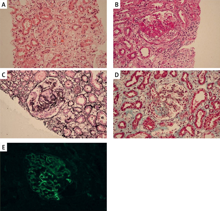 A novel heterozygous mutation in the gelsolin gene causes Finnish gelsolin amyloidosis associated with nephropathy and thrombotic microangiopathy.