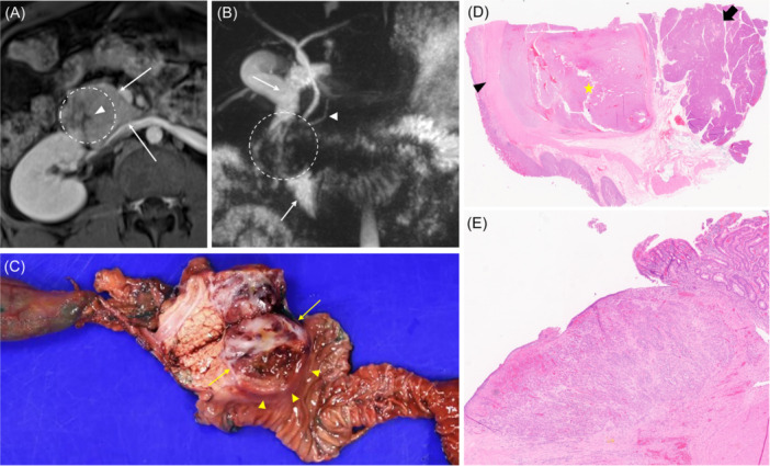 SPNing our wheels-Pancreatic solid pseudopapillary neoplasm as an extraluminal etiology of persistent duodenal ulceration.