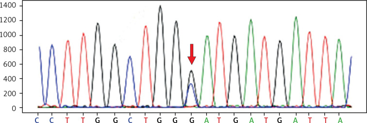A novel heterozygous mutation in the gelsolin gene causes Finnish gelsolin amyloidosis associated with nephropathy and thrombotic microangiopathy.