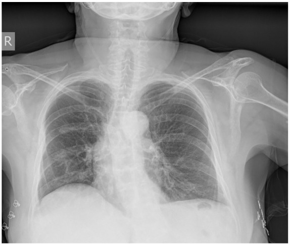 Pembrolizumab-induced myasthenia gravis with isolated diaphragmatic involvement in a lung cancer patient: a case report.