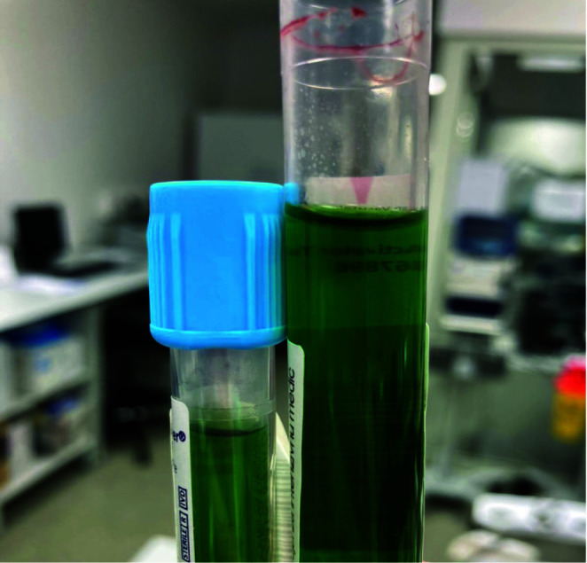 Understanding green discoloration in serum and citrate plasma samples: a case report.