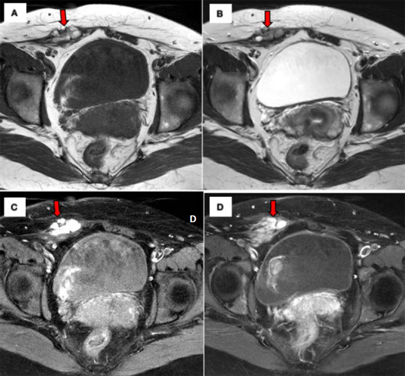 Spontaneous abdominal wall endometriosis: A case report.