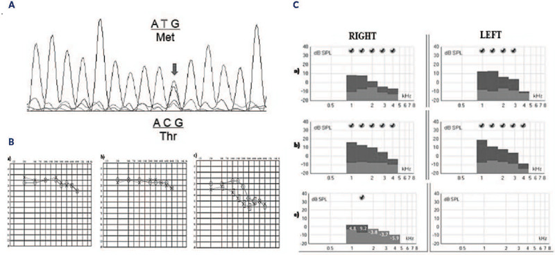 Audiological alterations in resistance to thyroid hormone syndrome: emphasizing lifelong assessment.