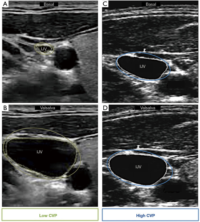 Ultrasound imaging of congestion in heart failure: a narrative review.