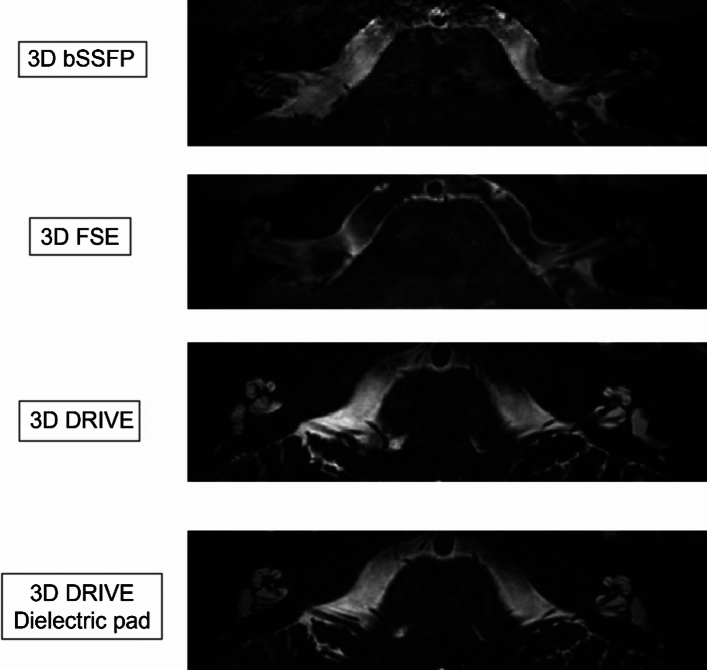 Morphology of the human inner ear and vestibulocochlear nerve assessed using 7 T MRI.