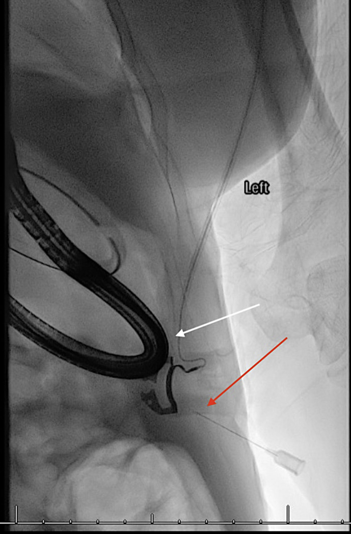 Hybrid Endoscopic/Fluoroscopic Gastrostomy Tube Placement: Case Report of a Novel Technique.