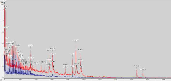 A Case of <i>Nocardia kroppenstedtii</i> Infection Successfully Treated With a Multidisciplinary Approach.