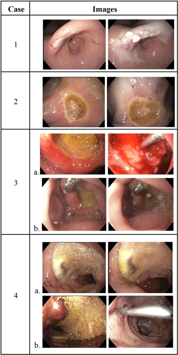 A clear approach: Hemostatic gel as a novel adjunct for pediatric upper gastrointestinal bleeding.