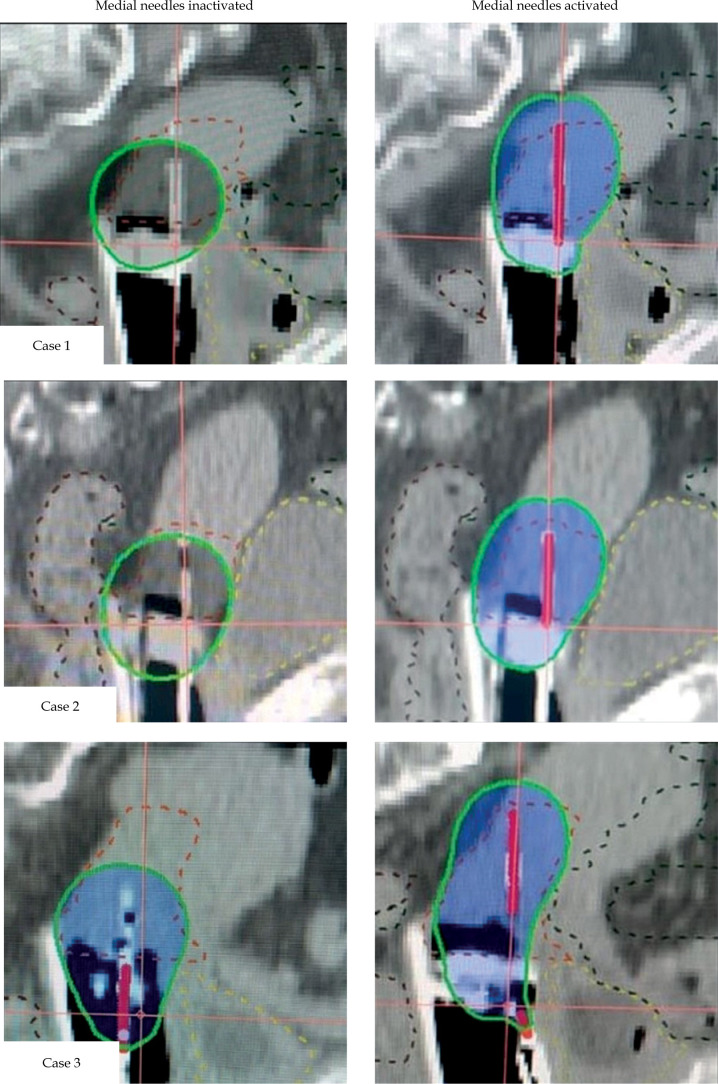 Efficacy of medial needles in mitigating dose deficits from sub-optimally inserted tandems in cervical interstitial brachytherapy.