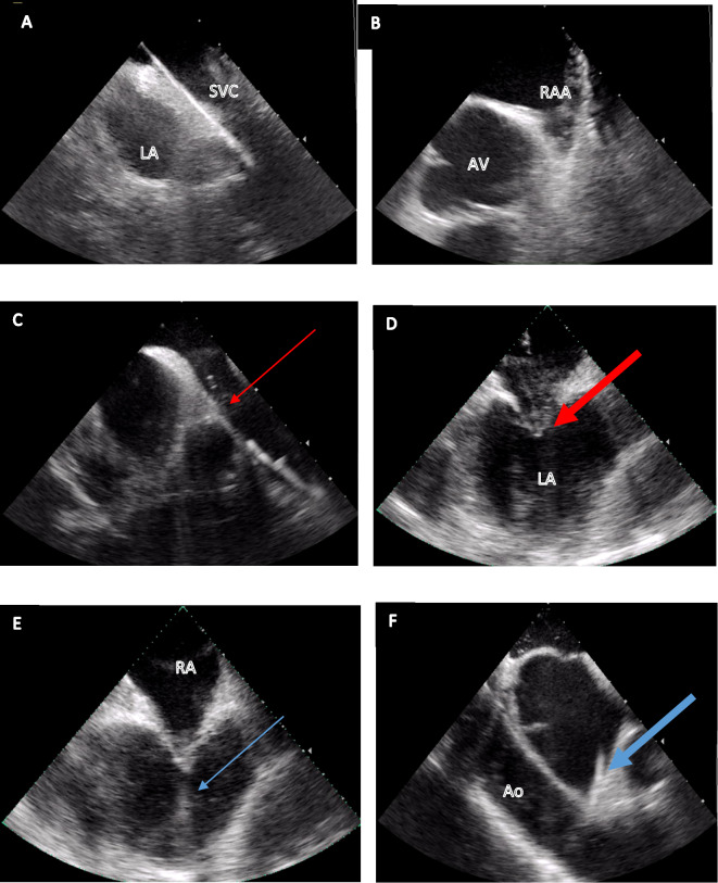 Feasibility and safety of zero-fluoro, "apron-less" approach to repeat pulmonary vein isolation procedures using radiofrequency energy after initial cryoballoon ablation.