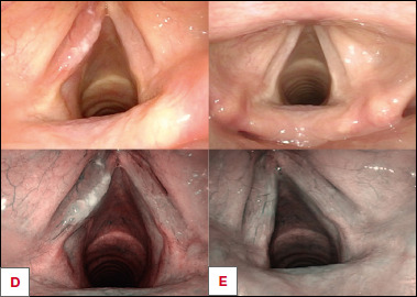 Complete response of laryngeal papillomatosis after HPV vaccination.
