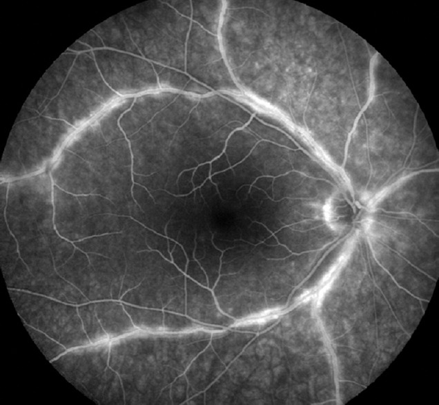 Specific retinal vasculitis in HLA-A29 birdshot retinochoroiditis, distinguishing it from other causes of vasculitis: A pilot study.