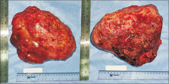 Seizing tumor factors for mortality and survival outcomes following liver resection in Indonesia's hepatocellular carcinoma patients.