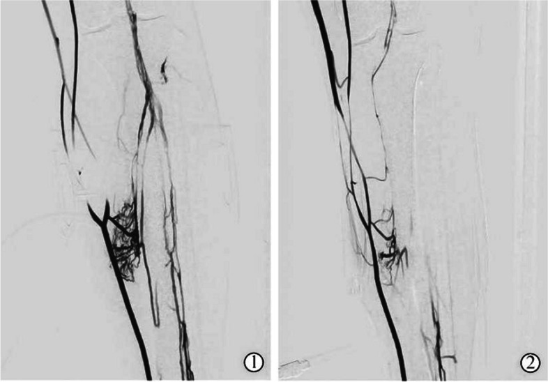 Effect of different balloon pressure band compression regimens on thrombolysis and lower limb venous blood flow velocity in patients undergoing anterograde thrombolysis via the superficial dorsalis pedis vein.