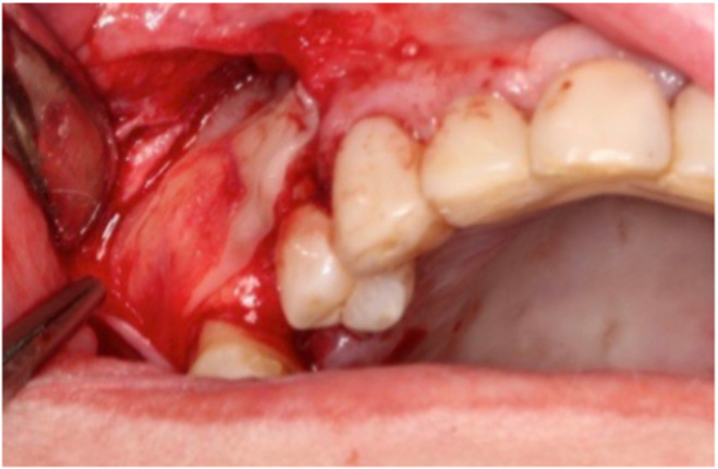 APCs in sinus floor augmentation.