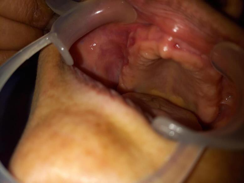 Oral Focal Mucinosis.