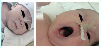 A Newborn Case of Esophagus and Vocal Cord Burn After CS (O-Chlorobenzylindene Malononitrile) Gas Inhalation.