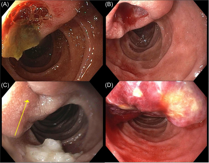 SPNing our wheels-Pancreatic solid pseudopapillary neoplasm as an extraluminal etiology of persistent duodenal ulceration.