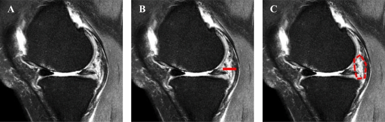 McMurray's test is influenced by perimeniscal synovitis in degenerative meniscus tears.
