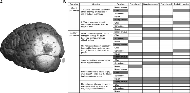 Lateral Occipital Cortex as a Novel Target for Neuromodulation to Attenuate Auditory and Visual Hallucinations in a Patient with Ultra-treatment-resistant Schizophrenia: A Case Report.