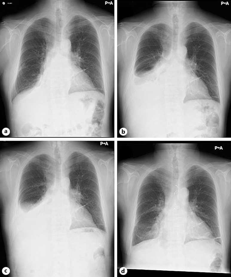 Constrictive Pericarditis in a Hemodialysis Patient Who Presented with Rapidly Progressive Pericardial Calcification: A Diagnostic Challenge - A Case Report.
