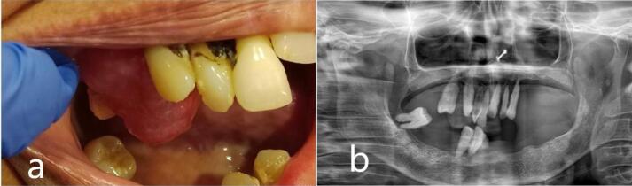 Oral Focal Mucinosis.