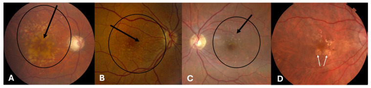 Modifiable Lifestyle Risk Factors and Strategies for Slowing the Progression of Age-Related Macular Degeneration.