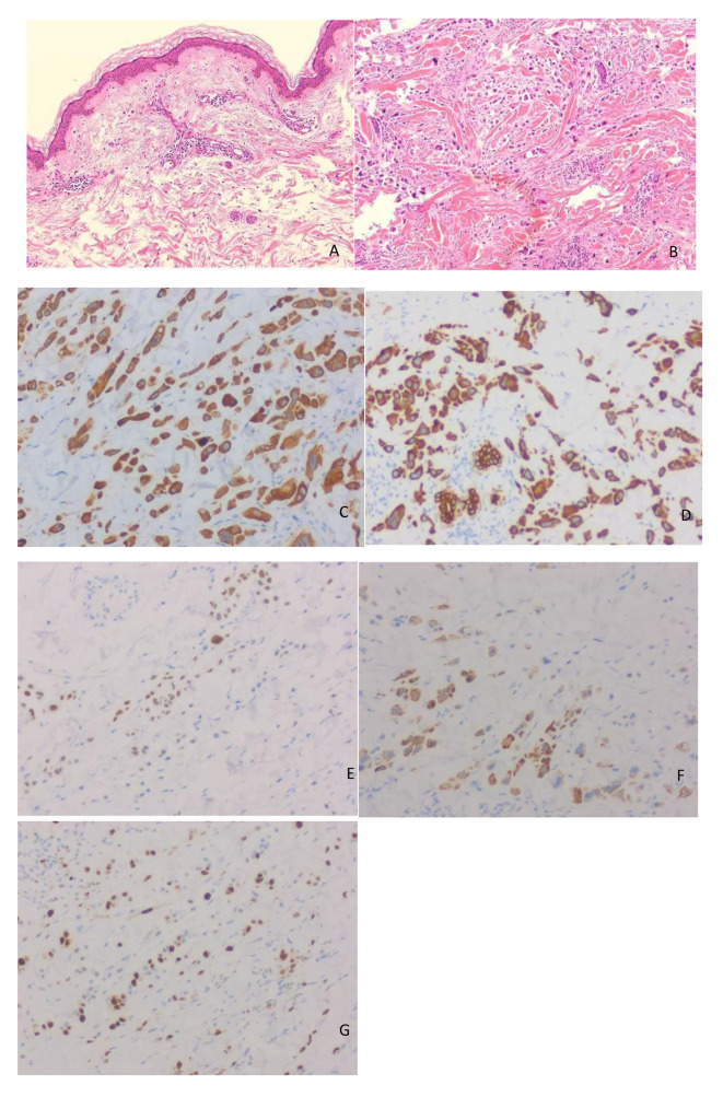 Clinicopathological diagnosis of morphea-like carcinoma en cuirasse in the neck: a rare presentation of lung cancer.