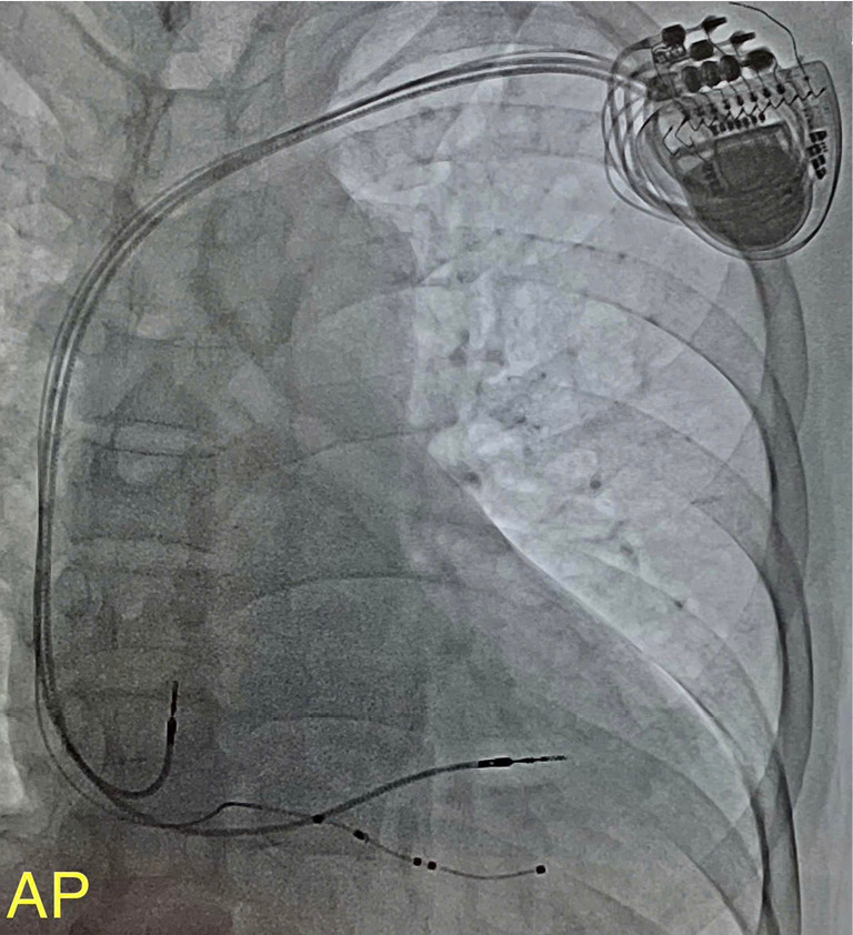 Evaluating the efficacy, safety, and predictors of failure following cardiac resynchronization therapy in a developing country: an ambispective, multi-center study.