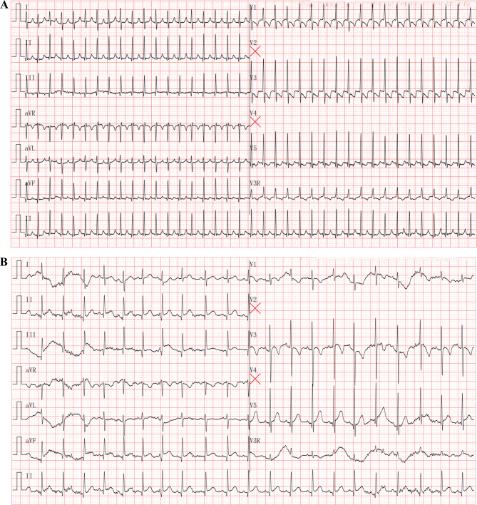 Infant Kawasaki disease complicated with supraventricular tachycardia: a case report and literature review.