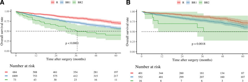 International Validation and Refinement of Oncological Borderline Resectability Criteria for Hepatocellular Carcinoma Using Tumor Burden Score to Predict Survival.