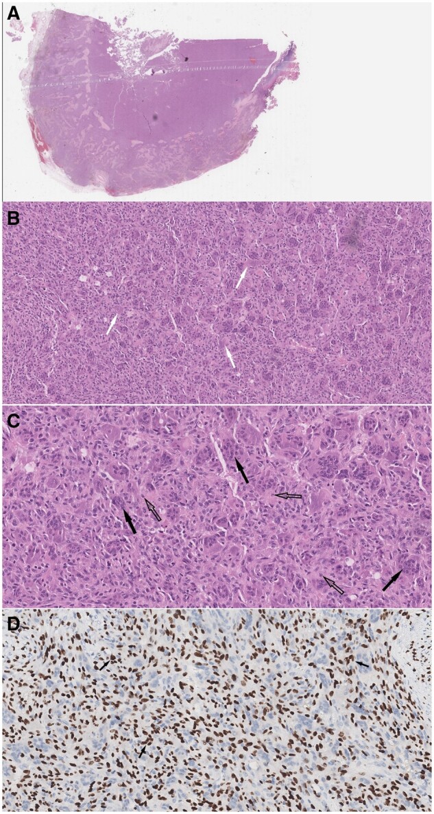 Giant cell tumour of the larynx-a diagnostic challenge.