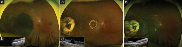 Surgical treatment of uveal melanoma: Exoresection versus endoresection.