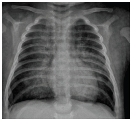 A Newborn Case of Esophagus and Vocal Cord Burn After CS (O-Chlorobenzylindene Malononitrile) Gas Inhalation.