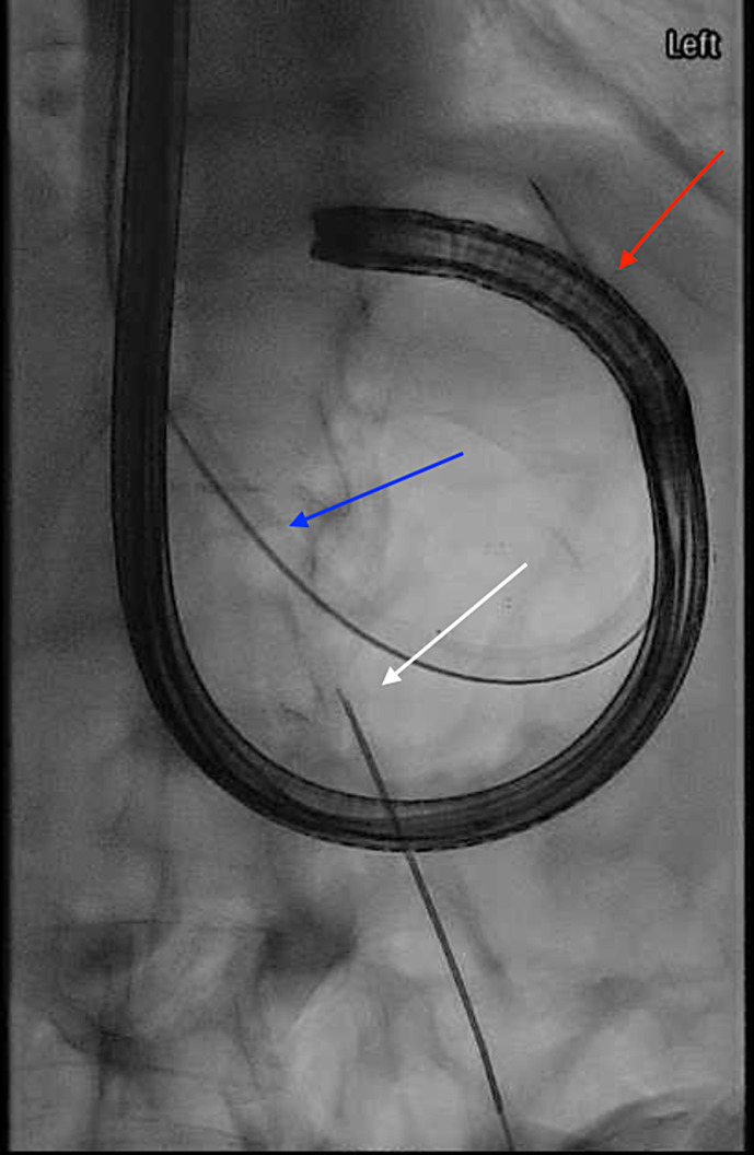 Hybrid Endoscopic/Fluoroscopic Gastrostomy Tube Placement: Case Report of a Novel Technique.