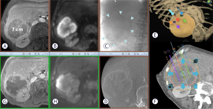 Comparison of selective intra-arterial to standard intravenous administration in percutaneous electrochemotherapy (pECT) for liver tumors.