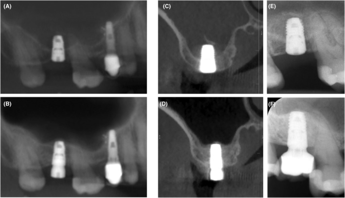 APCs in sinus floor augmentation.